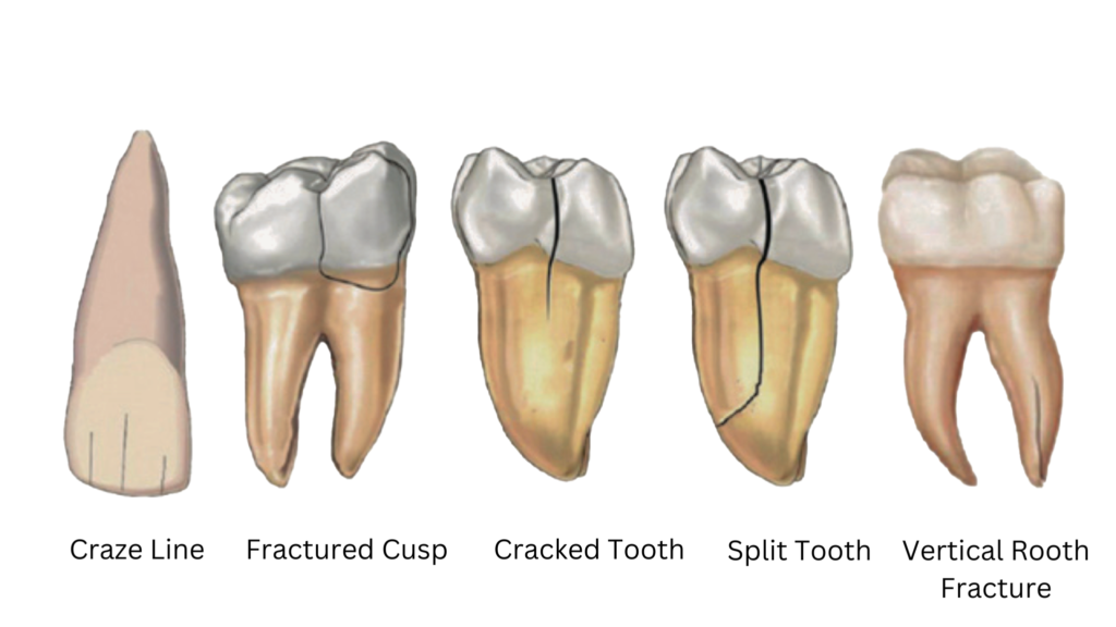 Cracked Teeth – Endodontics East County